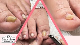 Ingrown Toenail Pedicure [upl. by Arraeic]