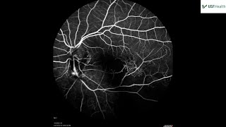 Branch Retinal Vein Occlusion with NVE and vitreous hemorrhage  Grant Slagle  2023 03 10 [upl. by Fitzpatrick]