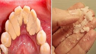 How to Get Rid of Plaque  Home Remedies for Plaque and Tartar [upl. by Idok786]