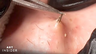 How Ingrown Hairs Are Removed  Art Insider [upl. by Aisined308]