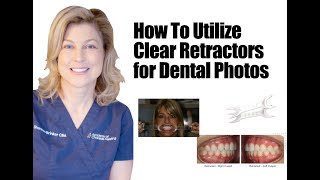 Top Retractors For Dental Photography  Invisalign amp Orthodontic Images [upl. by Hgielyak]