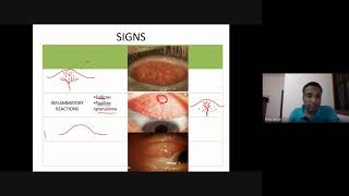 Conjunctival concretion in eye  Causes and treatment  Sign and symptoms  home remedies  eyedrops [upl. by Aleahcim]