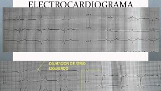 CARDIOPATIA HIPERTENSIVA Y DISFUNCION VENTRICULARwmv [upl. by Nyliak850]