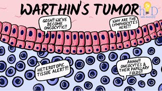 Warthins tumor [upl. by Gilcrest]