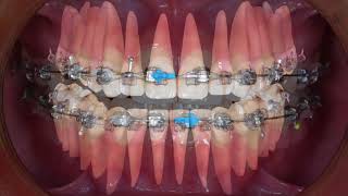 Clinical tip Midline Correction with Intermaxillary Elastics｜【Chris Chang Ortho】CC451 [upl. by Mauri]