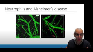 Neuroinflammation in Alzheimers Disease The Role of Neutrophils [upl. by Stoller330]