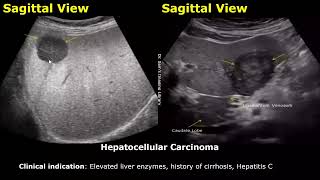 Liver Ultrasound Reporting  Liver Diseases Scan Reports  How To Write USG Report  Abdominal USG [upl. by Anirtek]