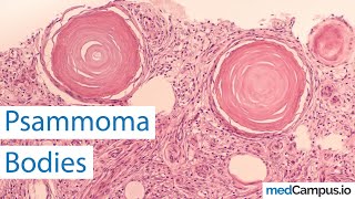 Psammoma bodies  Pathological bodies [upl. by Paddie]