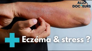 Eczéma  quelles solutions   Allo Docteurs [upl. by Trah]