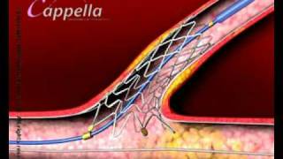 Stent insertion [upl. by Demeyer]