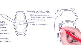 Acute Tonsillitis  causes viral bacterial pathophysiology treatment tonsillectomy [upl. by Aihsad]