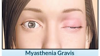 Myasthenia Gravis causes of myasthenia gravis clinical features of myasthenia gravis [upl. by Isador]