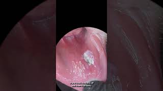 A new way to treat canker sores aphthous ulcers dentalhygiene dentalpain cankersores [upl. by Letnoj510]