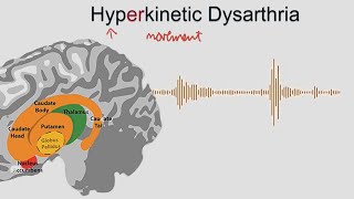 Hyperkinetic Dysarthria  samples and explanation [upl. by Modnar]