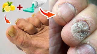 Say Goodbye to Nail Fungus Forever with This Treatment [upl. by Adnim]