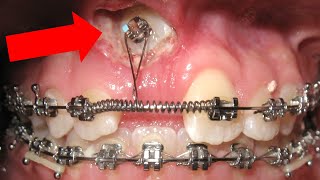 🔥Unexpected orthodontic impaction🔥 and OPEN BITE timelapse HOW BRACES WORK [upl. by Marne]