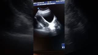 Nabothian cyst ultrasound [upl. by Zilla203]