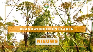 Brandwonden en blaren [upl. by Dace]