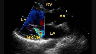 Post BMV Echocardiogram [upl. by Irneh]