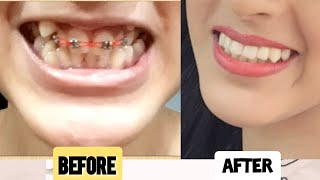 DentalTeeth transformation  Before and after braces removal  Braces timelapse [upl. by Vonni]