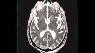 Cryptococcal meningitis [upl. by Matthaus]