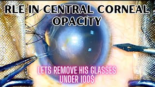 Refractive lens exchange in high myopia and central corneal opacity [upl. by Meares]