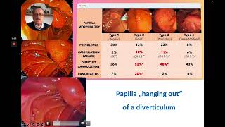 ERCP  Precut Sphincterotomy Using the Huibregtse Needle KnifeBiliary Catheter [upl. by Dranyl733]