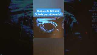 BIOPSIA DE TIROIDES GUIADA PPR ULTRASONIDO [upl. by Aylad361]