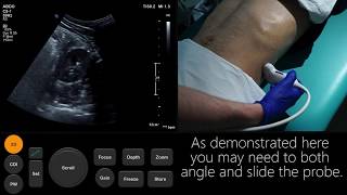 Ultrasound Tutorial Kidney amp Bladder  Urinary Tract  Radiology Nation [upl. by Olympe]