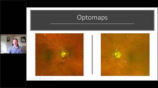 Using the RETeval ERG for Glaucoma w Dr Mike Cymbor OD [upl. by Four657]