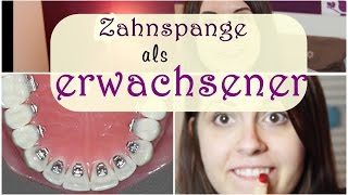 Zahnspange bei erwachsenen  Lingualtechnik  Kosten  JuMarie [upl. by Ecnadnac]