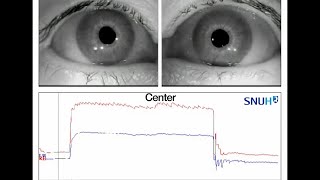 Bilateral Internuclear Ophthalmoplegia Observed in Anti–GQ1b Antibody Syndrome [upl. by Esirtal241]