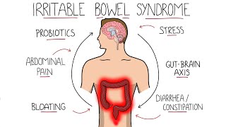 Irritable Bowel Syndrome IBS  Including Symptoms Criteria amp Treatment [upl. by Estel]