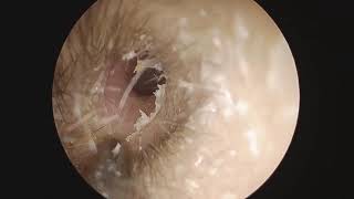 quotEar Canal Eczema and Earwax Cleaningquot [upl. by Kcirednek]