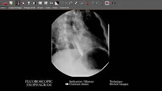 FL Esophagram  Search Pattern [upl. by Ibur]