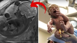 This Mom Gave Birth To A Healthy Baby But When Doctors Saw Her Placenta They Left It Inside Her [upl. by Akihc]