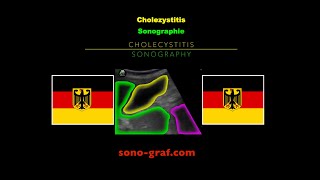 Sonographie  Cholezystitis [upl. by Eirrej903]