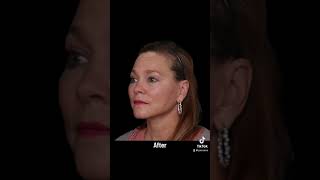 Facelift Surgery Before amp After  Facial Plastic Surgeon Dr Robert Glasgold [upl. by Nerraf306]