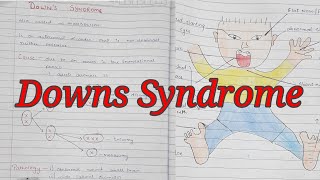 Downs Syndrome  Trisomy 21  Mongolism  Notes With Diagrams To Understand Better  Cx and Features [upl. by Rachael73]