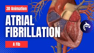 Atrial Fibrillation AFib  3D Animation [upl. by Ellennaj122]