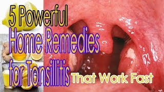 5 Powerful Home Remedies for Tonsillitis That Work Fast [upl. by Annaig]