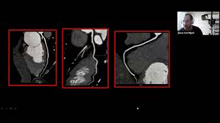 Clase 15  Angiotomografía en la enfermedad coronaria [upl. by Atiragram]