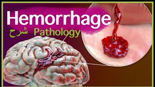 Pathology  Hemorrhage  Blood Hemodynamic disorders شرح باثو [upl. by Edwine]