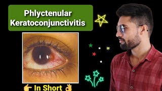 Phlyctenular keratoconjunctivitis lecture opthalmology [upl. by Arahahs]