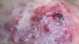 CYSTIC ACNE REMOVAL  Inflammatory Acne Acne Skin Treatment [upl. by Zane358]