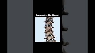 Degenerative disc disases thephysiodoctoranatomyneurosciencebrainneuronaphysiotharapist [upl. by Eam768]