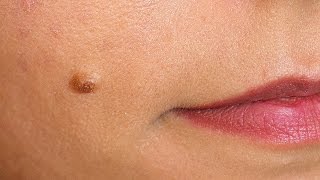 Indepartarea alunitelor fara cicatrici  Radiofrequency removal of facial nevus [upl. by Philis]