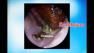 Nail Hard ear wax removal ep13 [upl. by Igal]