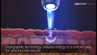 Acne Scars Removal  Picoway Resolve Teaser 3D Medical Device Animation [upl. by Biegel726]