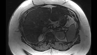 Hepatic Steatosis [upl. by Alathia794]